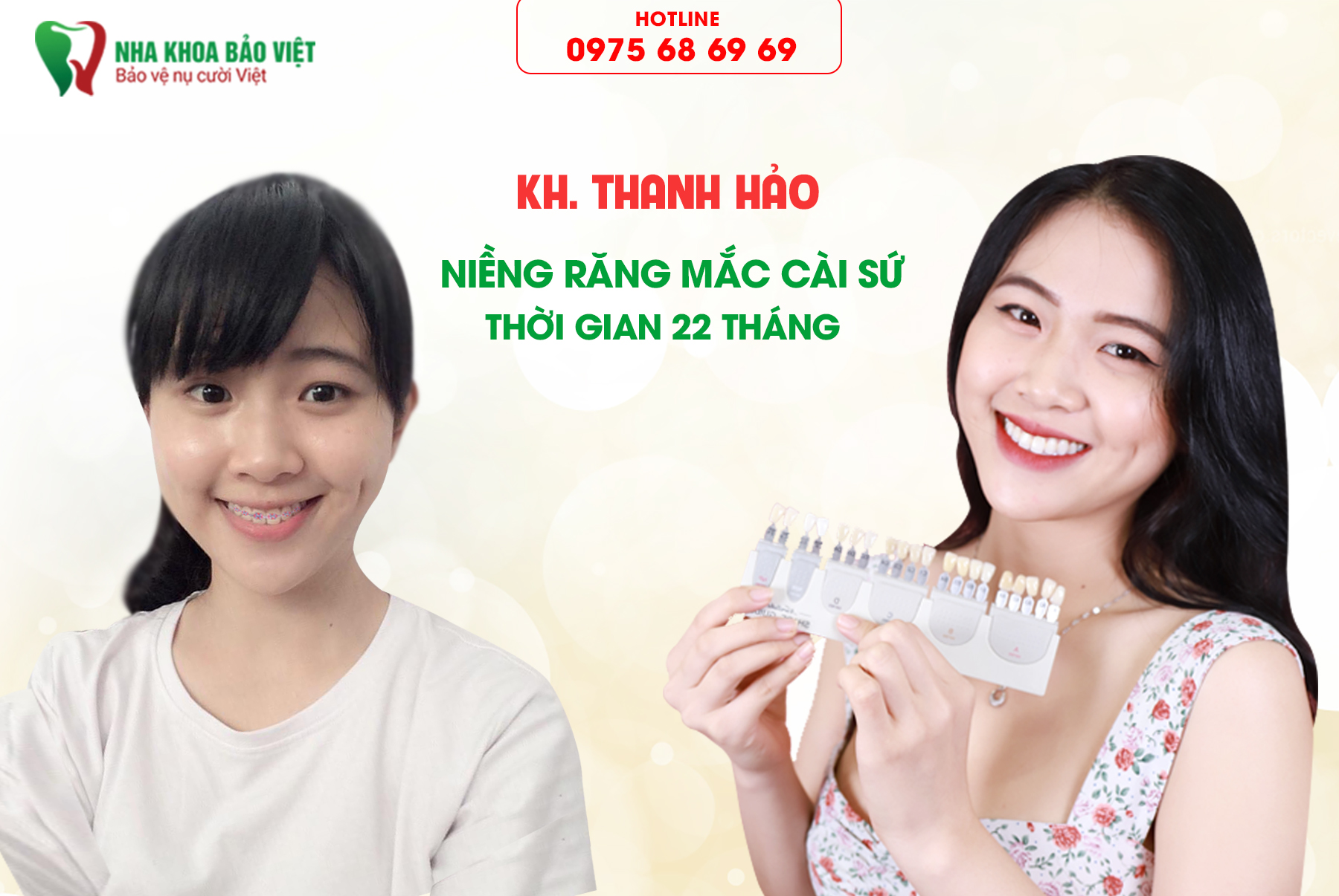 Khách hàng sau khi niềng răng