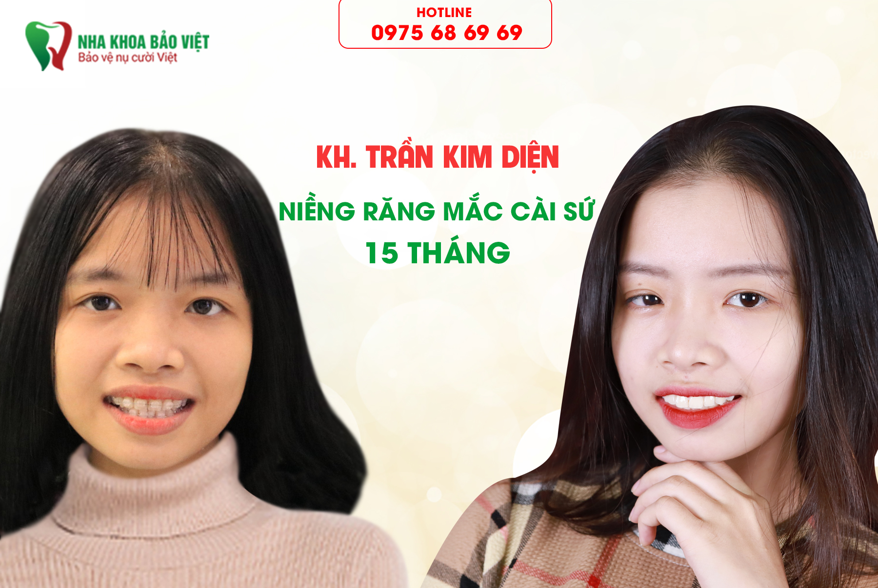 Khách hàng sau khi niềng răng