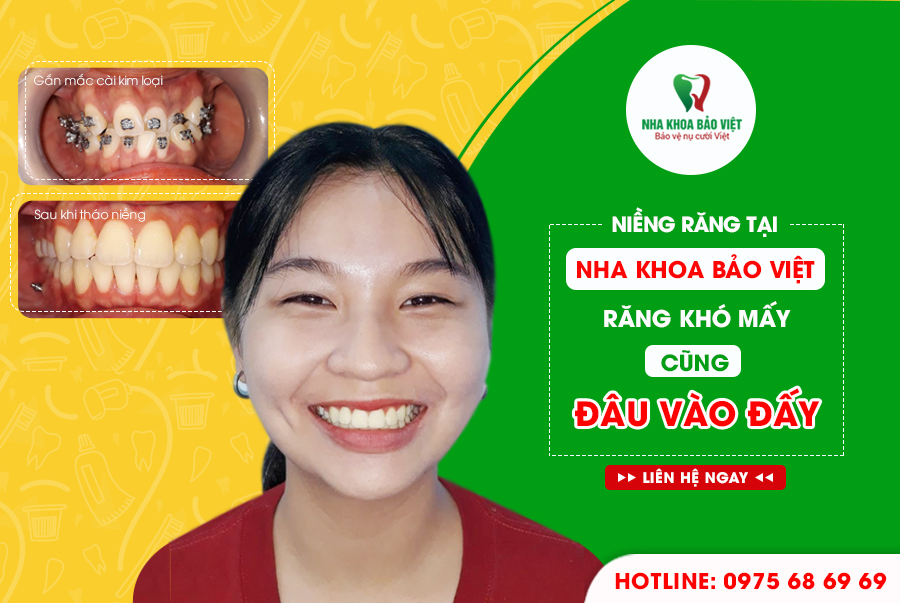 Khách hàng sau khi niềng răng