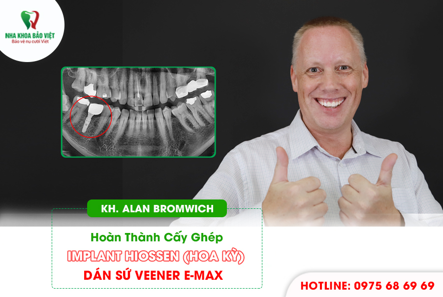 Khách hàng sau khi trồng răng implant