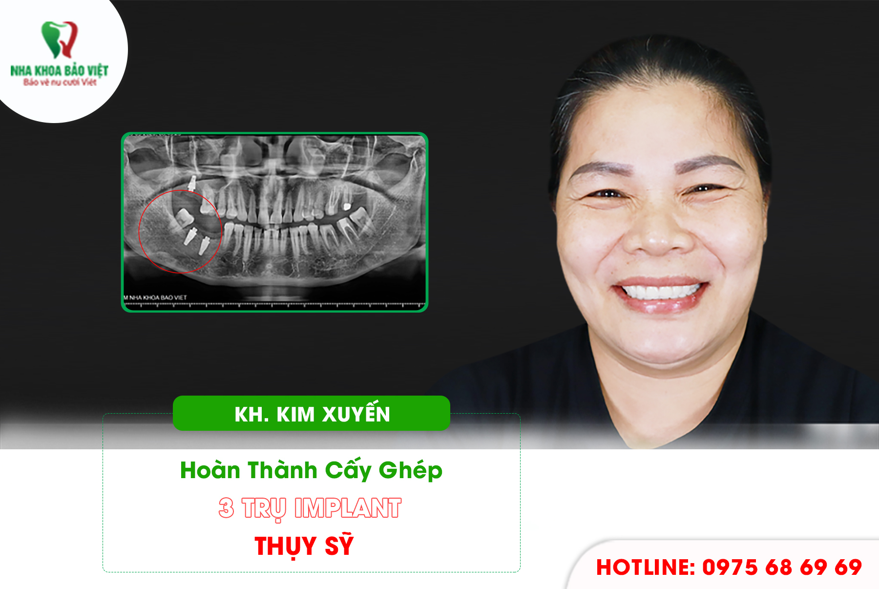 Khách hàng sau khi trồng răng implant