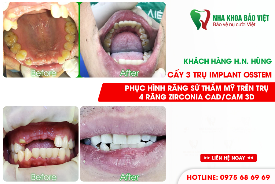 Khách hàng sau khi trồng răng implant