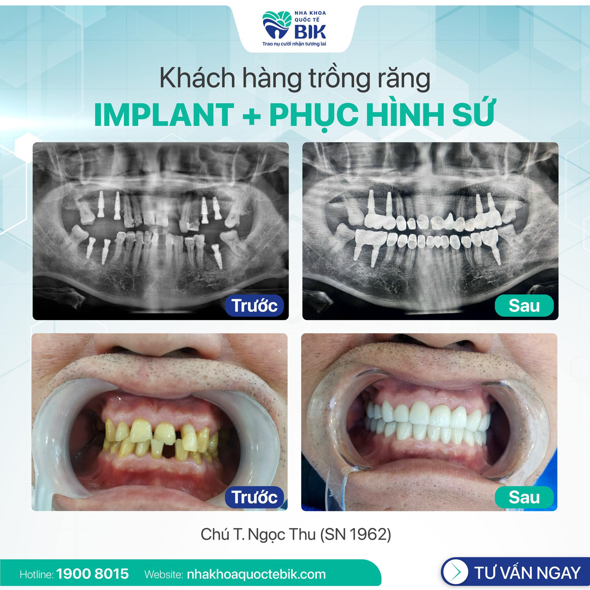 Customer implanting teeth at BIK DENTAL