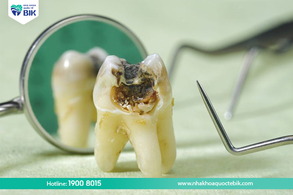 When do you need to make your decayed teeth fall out quickly?