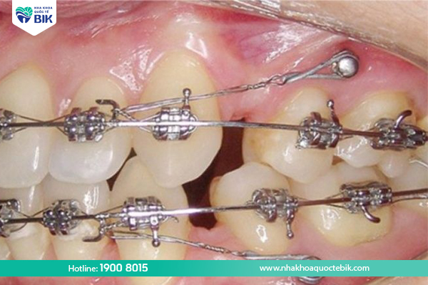 When to remove braces screws