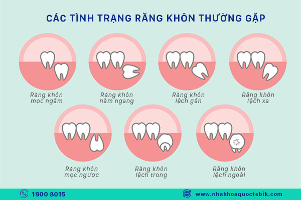 khi nào răng khôn cần phải nhổ