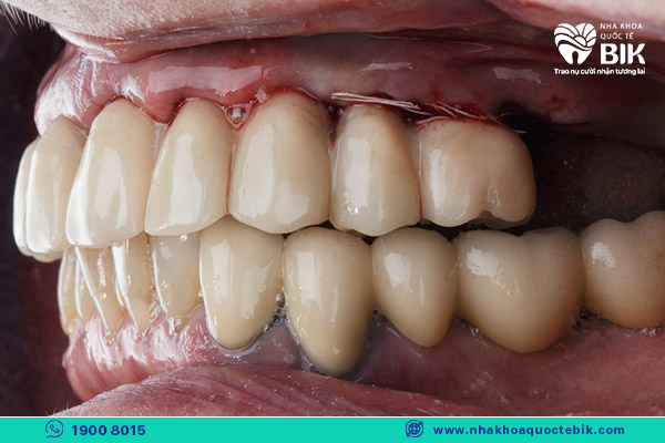 Not taking good care of your teeth leads to harmful effects when covering your teeth with porcelain