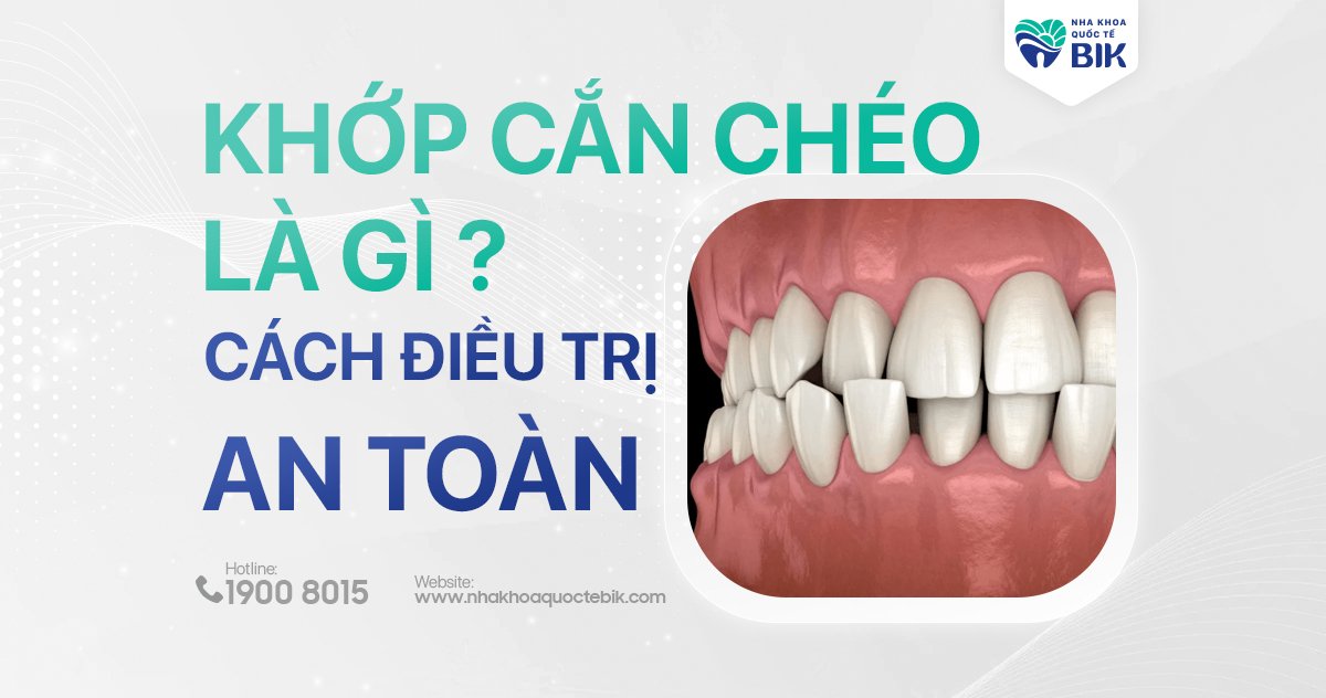 Khớp cắn chéo là gì?