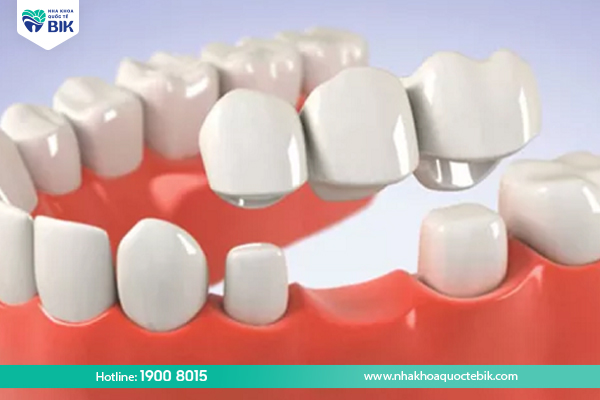 Making a porcelain bridge when losing a molar