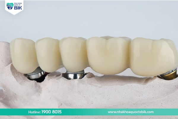 Making a porcelain bridge to restore decayed teeth