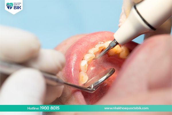 periodic dental scaling