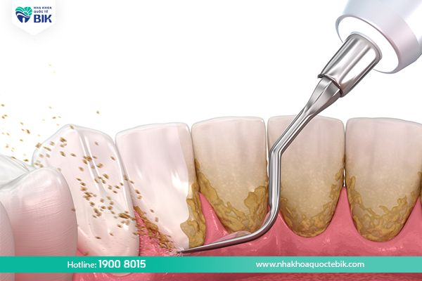 Scaling to treat gums not adhering firmly to the tooth root