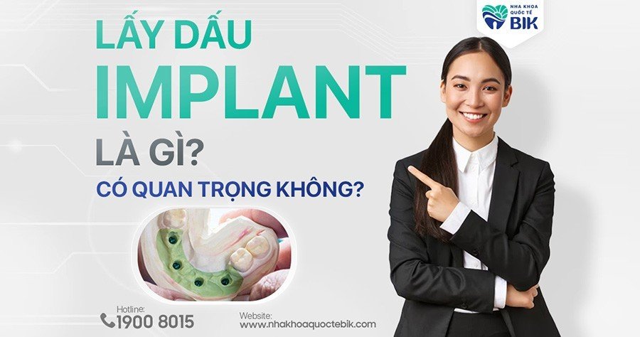 lay-dau-rang-implant