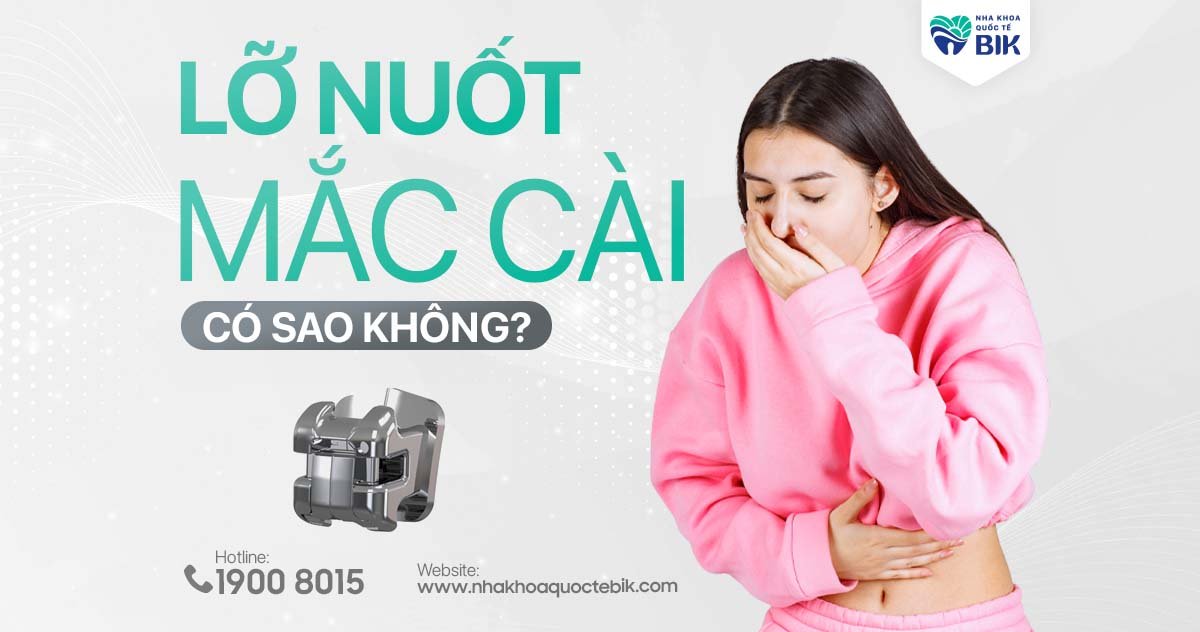 Lỡ nuốt mắc cài niềng răng