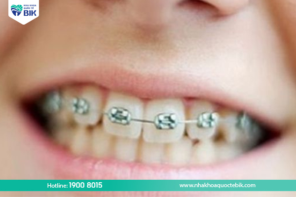 Benefits of braces for children at the right time