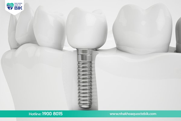 tuoi-tho-rang-implant