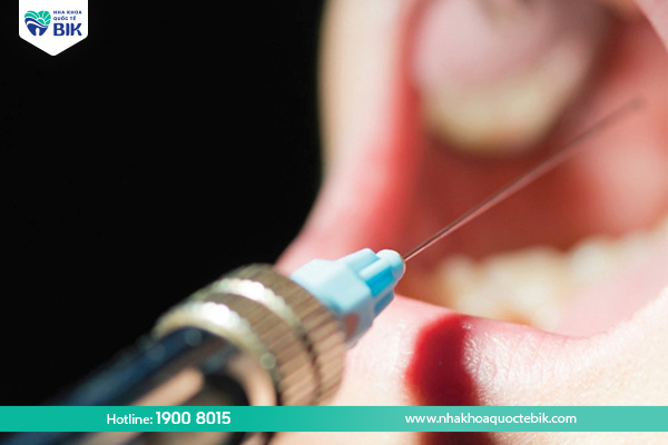 Notes when injecting anesthetic for tooth extraction