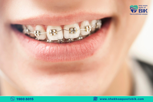 choosing the type of braces affects the time of braces