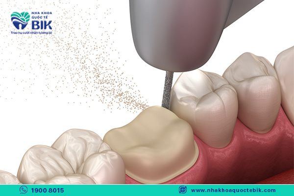 technique that determines the safety of porcelain crowns