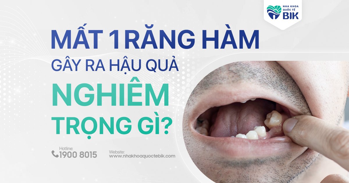 Mất 1 răng hàm phải làm sao