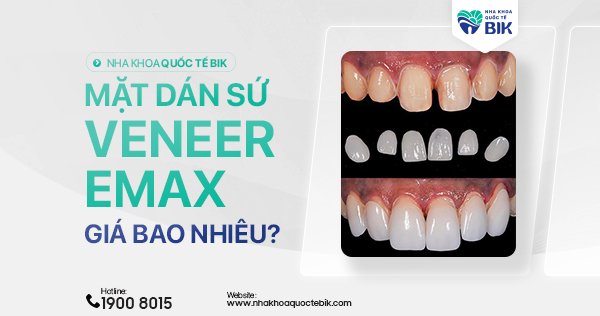 mat-dan-su-veneer-emax