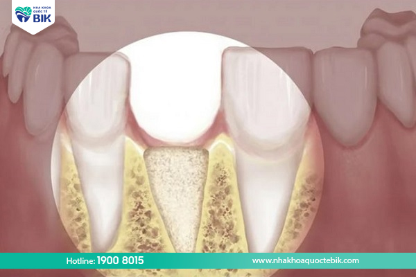 How long does it take for tooth loss to cause jaw bone loss?