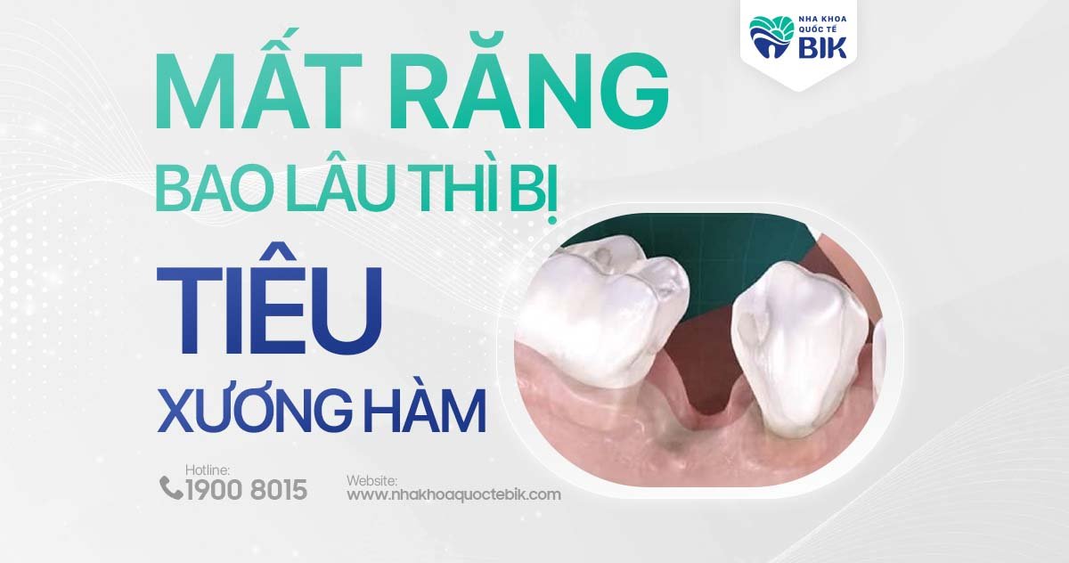 Mất răng bao lâu thì bị tiêu xương hàm