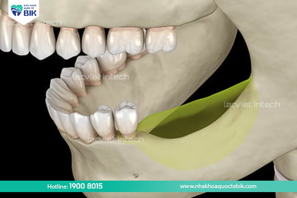 Tooth loss causes jawbone loss