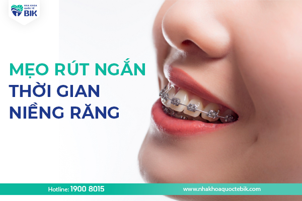 Mẹo rút ngắn thời gian niềng răng