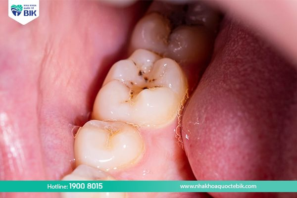 Damaged tooth enamel