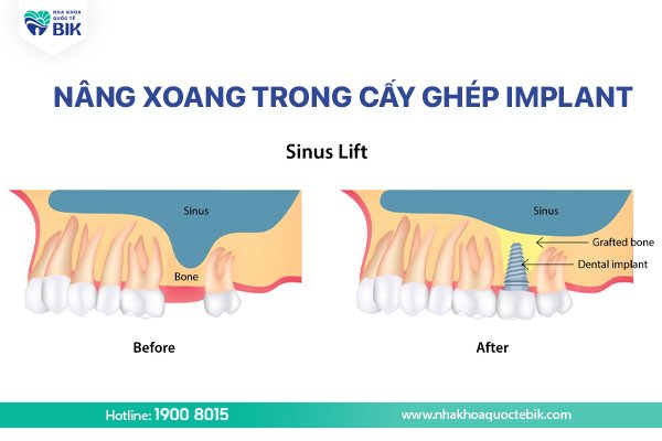 nang-xoang-ghep-xuong