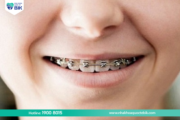 When should children get braces?