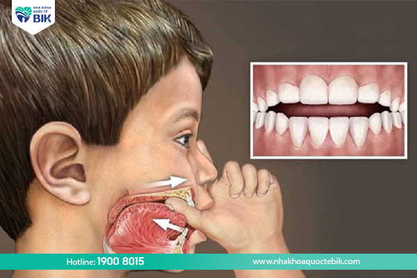 Causes of crossbite