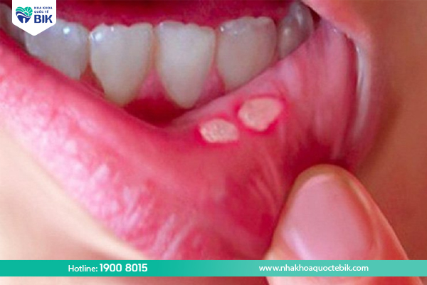 Causes of mouth ulcers