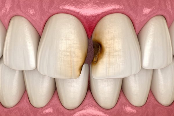 Causes of interdental caries