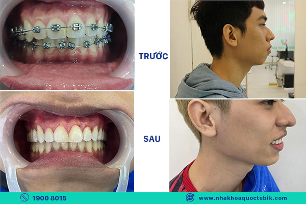 Reputable orthodontic clinic for buck teeth