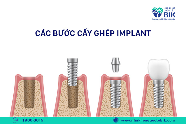 nen-trong-rang-su-hay-implant