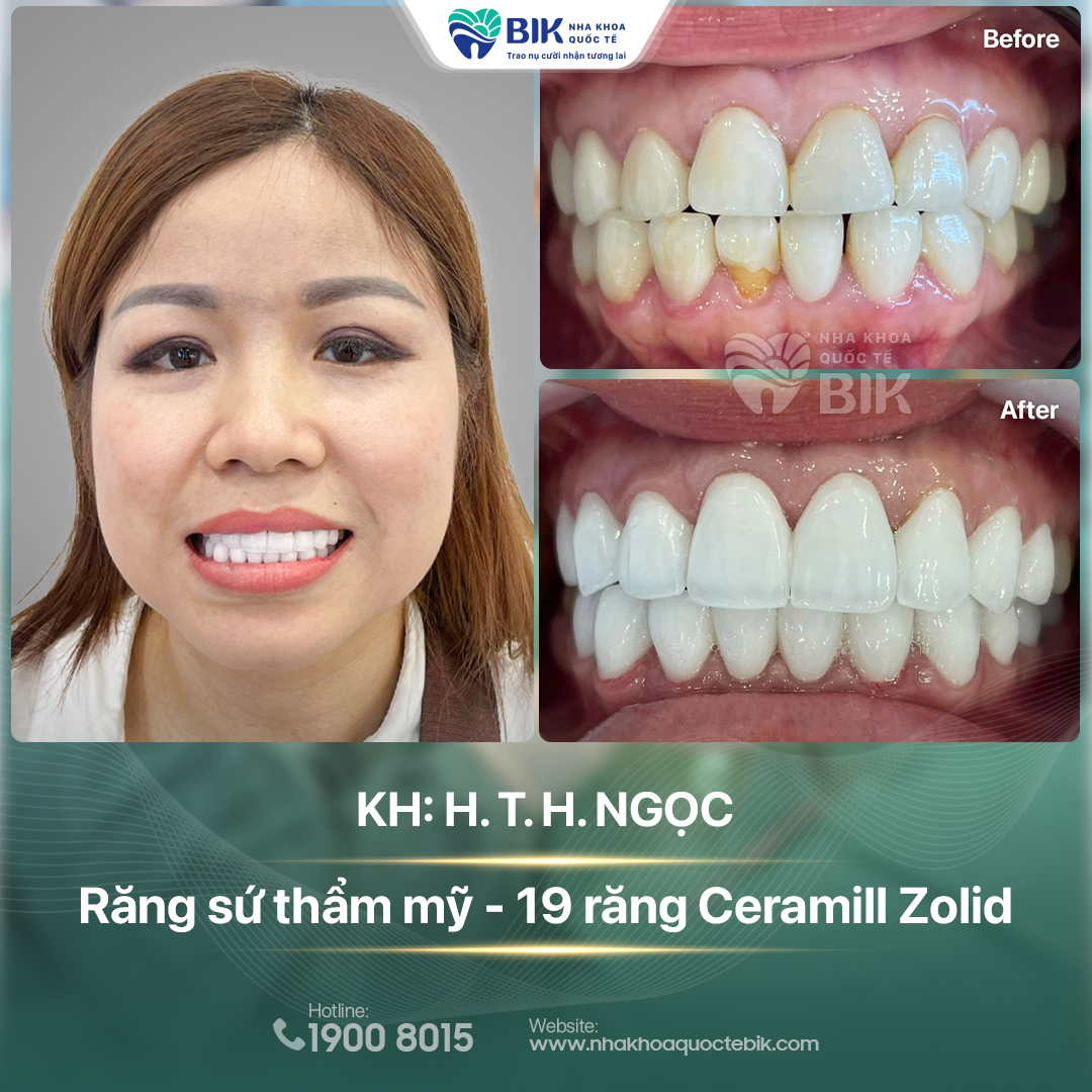 Nha khoa bọc răng sứ uy tín