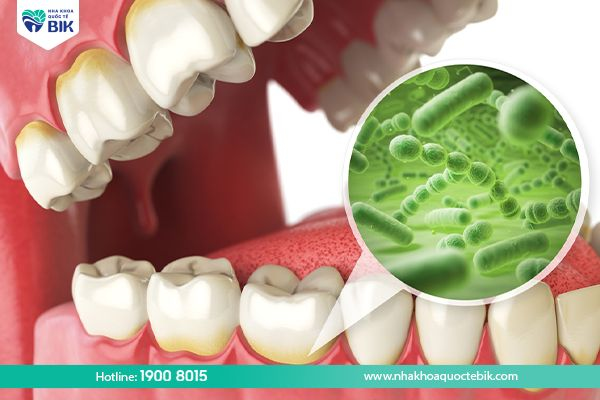 What is tooth root infection?