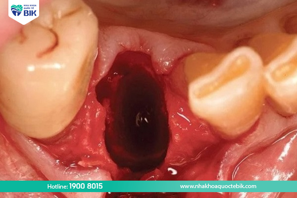 What is infection after wisdom tooth extraction?