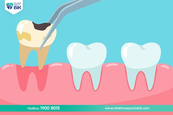 Is it okay to extract a decayed wisdom tooth