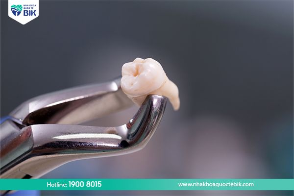 Wisdom tooth extraction to treat pericoronitis