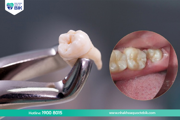 Extraction of impacted wisdom teeth