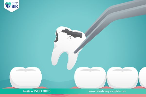 Extracting a severely decayed tooth