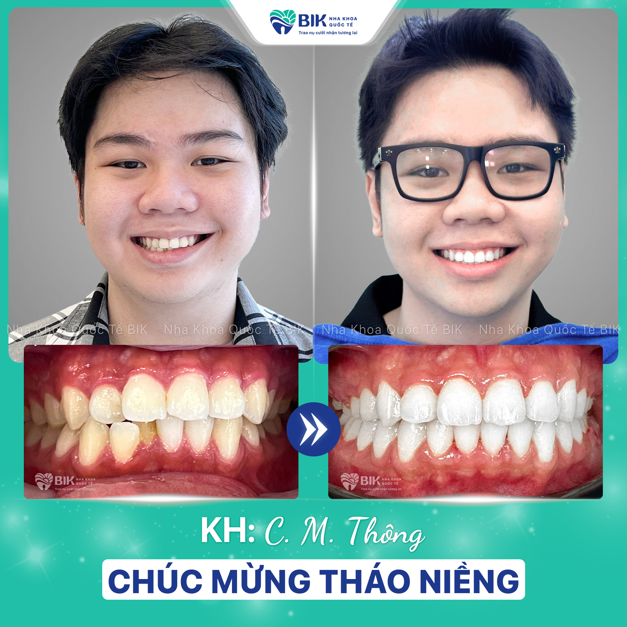 Nha khoa niềng răng hô uy tín