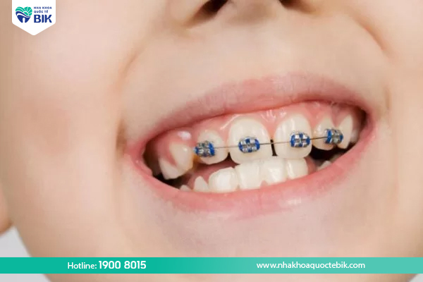 Braces to correct congenital tooth loss