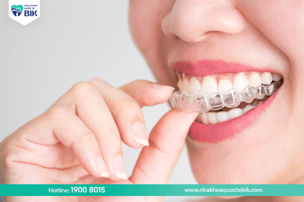 What are invisible braces?