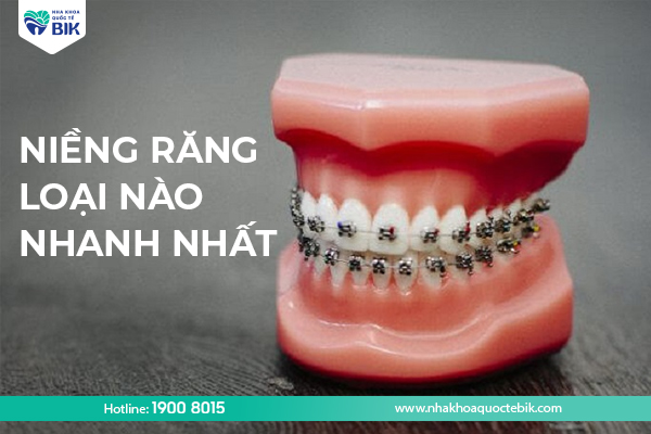 Niềng răng loại nào nhanh nhất