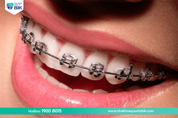 Metal braces