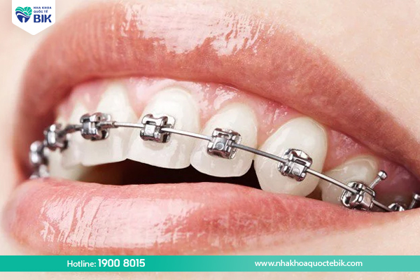 Metal braces